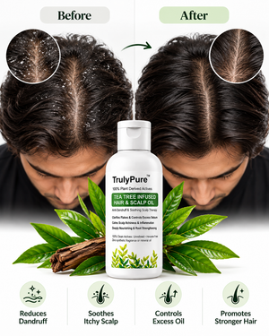 Tea Tree Infused Hair & Scalp Oil: Anti-Dandruff & Soothing Therapy for Flakes, Itchiness & Excess Sebum